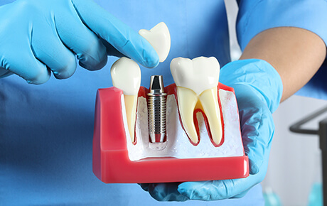 歯周病とインプラント