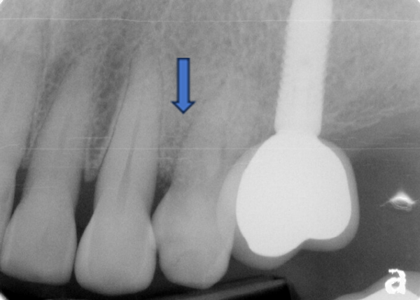 歯周組織再生療法 症例①治療後