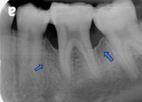 歯周組織再生療法 症例②治療後