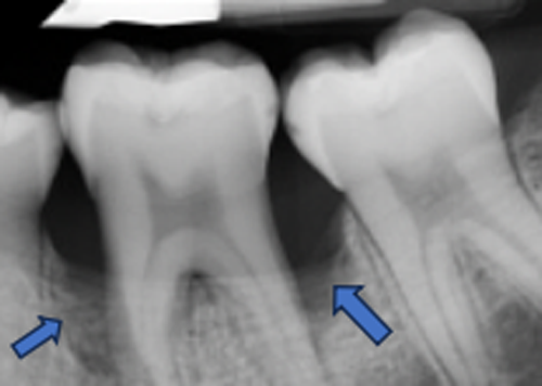 歯周組織再生療法 症例②治療前
