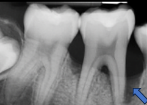 歯周組織再生療法 症例③治療前